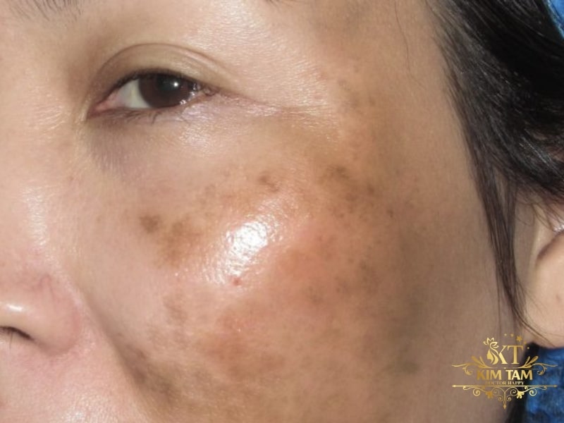 cách trị nám gò má tại nhà