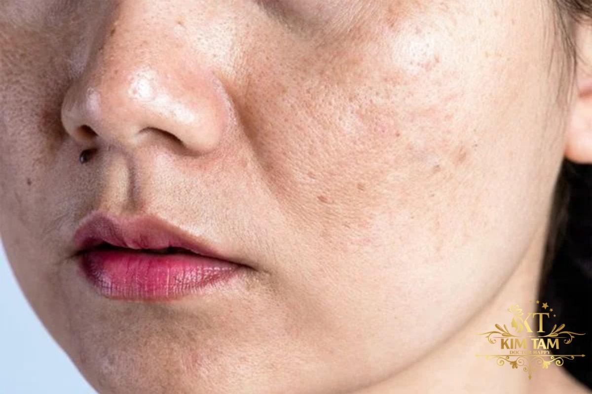dưỡng da nám với melasma collagen