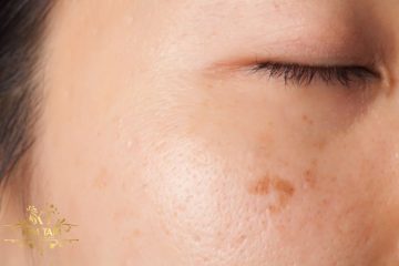 trị nám từ bên trong - ăn gì và không ăn gì