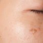 trị nám từ bên trong - ăn gì và không ăn gì