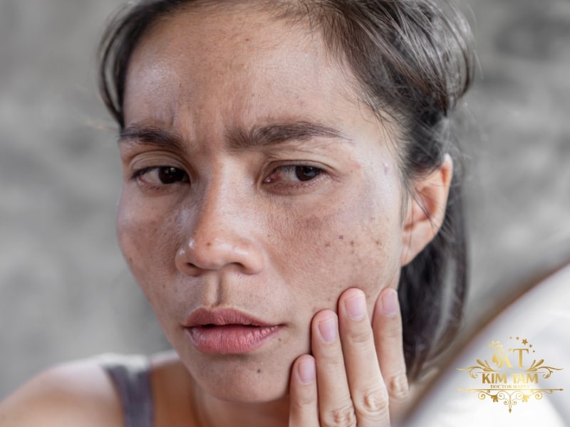 trị nám từ bên trong
