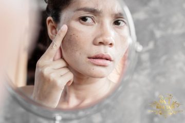 cách trị nám gò má tại nhà