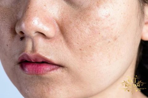 tình trạng nám da