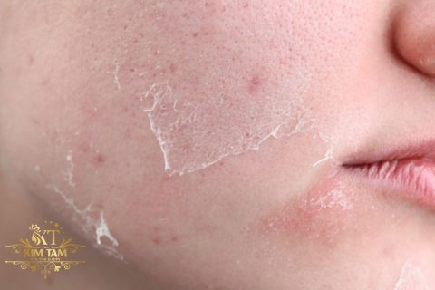 melasma detox peel review