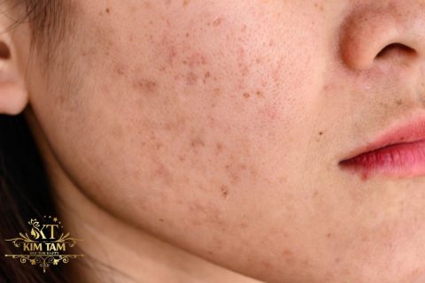 kem chống nắng cho da nám