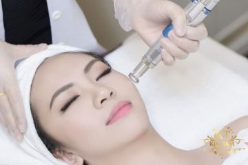 trị nám bằng laser