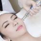 trị nám bằng laser