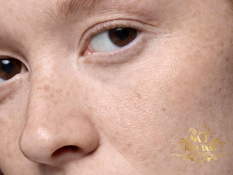 ăn gì trị nám da mặt nhanh hiệu quả