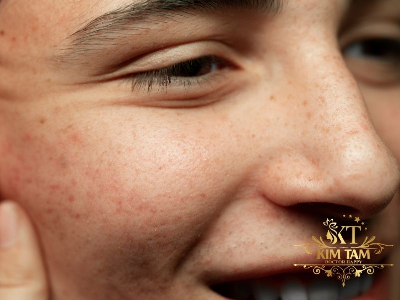 cách trị nám da mặt sau khi sinh 1